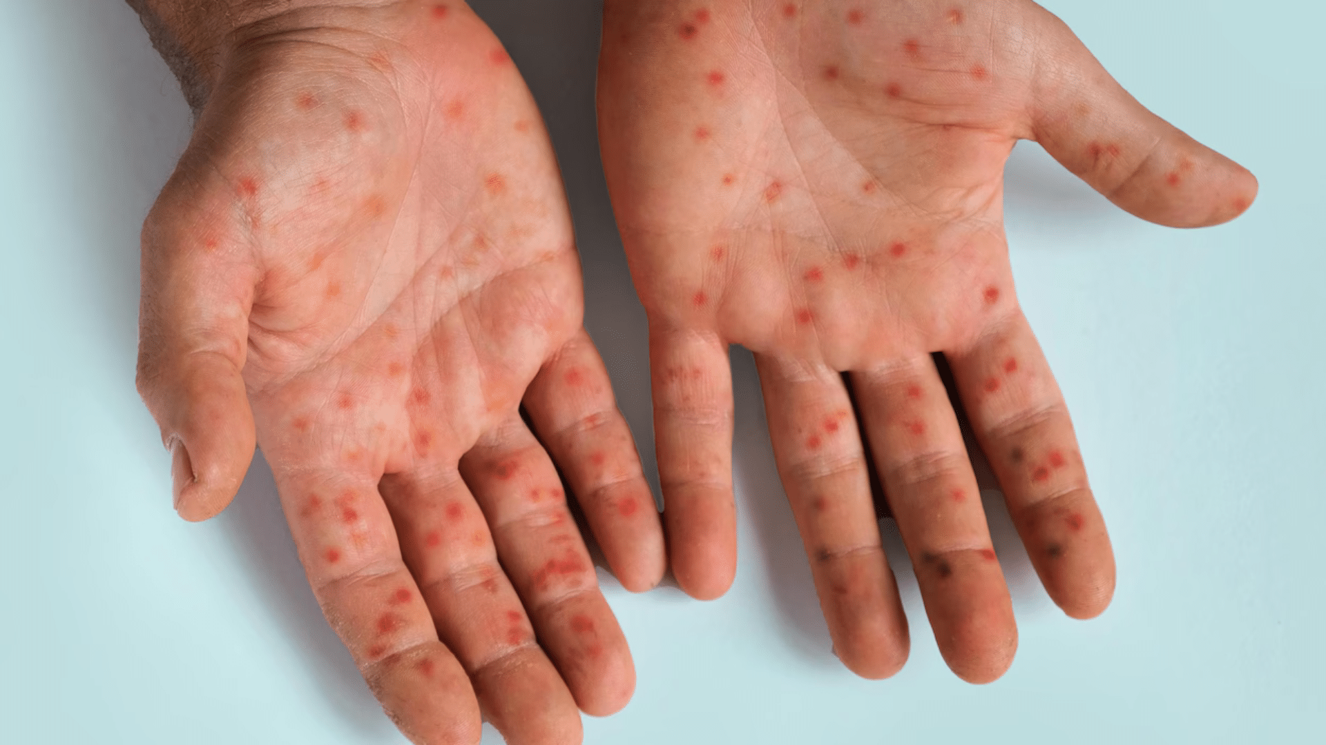 Chichaoua: 7 enfants sont décédés à cause de la rougeole