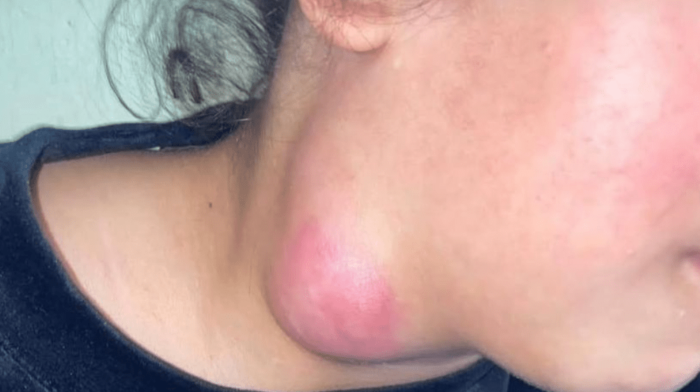 Tuberculose
